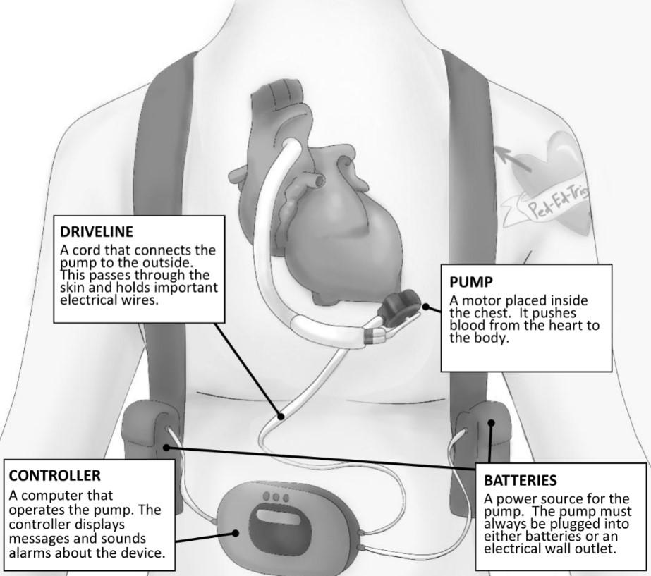 LVADs Not Just for Big People Anymore